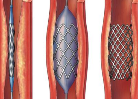 好消息！700元冠脈支架來(lái)了帶量采購(gòu)結(jié)果在甘肅省正式落地執(zhí)行